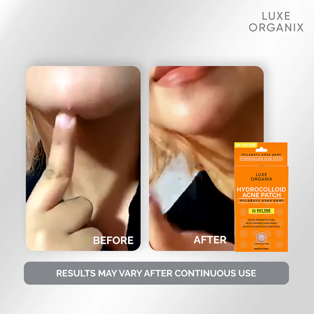 Luxe Organix Hydrocolloid Acne Patch – Day Time (48 Patches) - Image 4